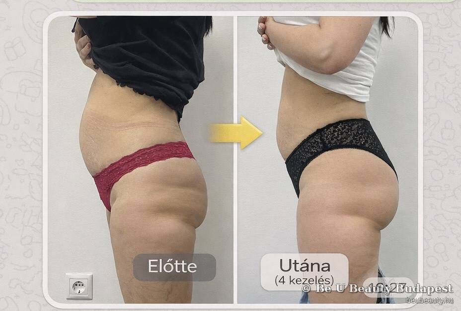 Has kavitáció előtte-utána